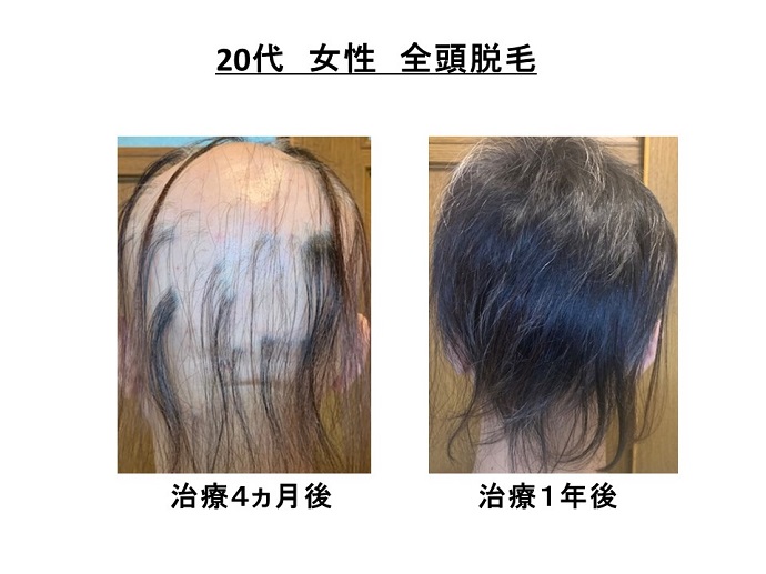 円形脱毛症　病院